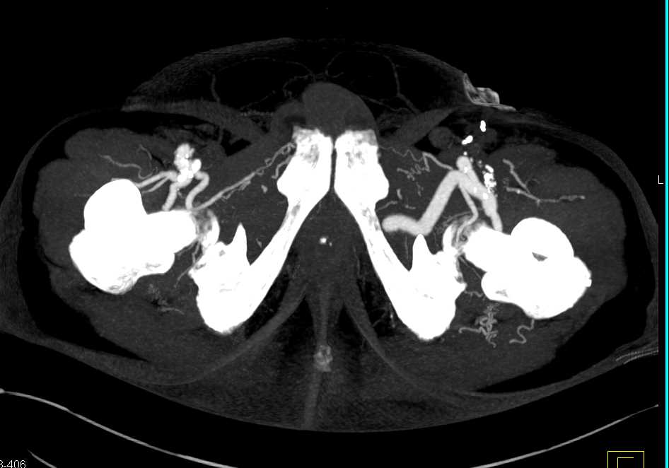 Femoral Artery Bypass through the Obturator Foramen - CTisus CT Scan
