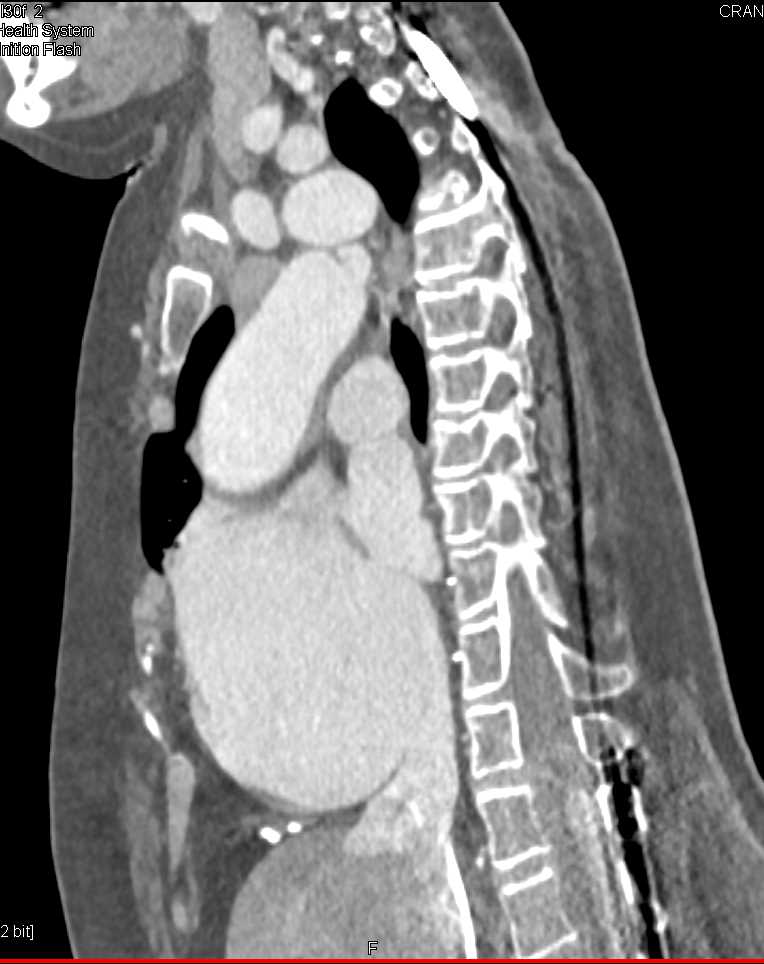 Ectatic Arch Vessels in Loeys-Dietz Syndrome - CTisus CT Scan