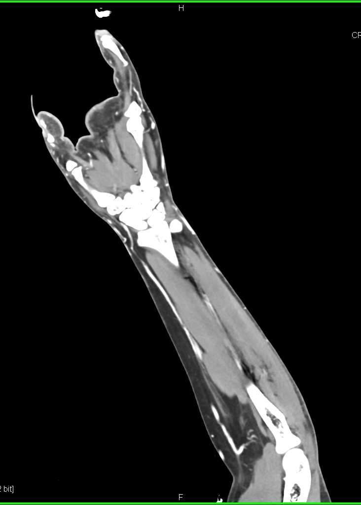 CTA Mapping of the Wrist and Hand - CTisus CT Scan
