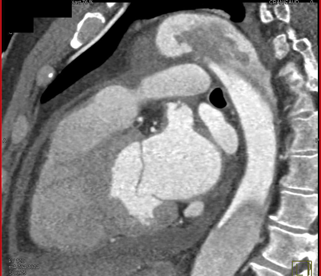 Type A Dissection - CTisus CT Scan