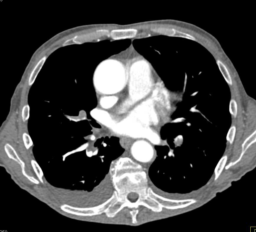 Occluded Left Popliteal Artery by Clot in Patient with Multiple Pulmonary Emboli as Well - CTisus CT Scan
