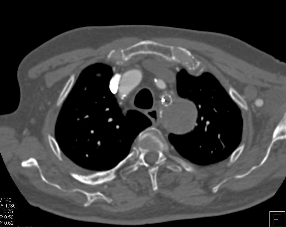 Occlusion Left Subclavian Artery with Bypass from the Left Carotid Artery - CTisus CT Scan