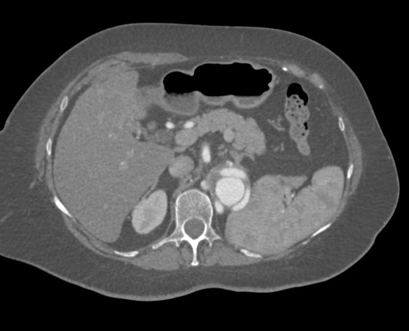 Aortic Aneurysm with Vascular Grafts - CTisus CT Scan