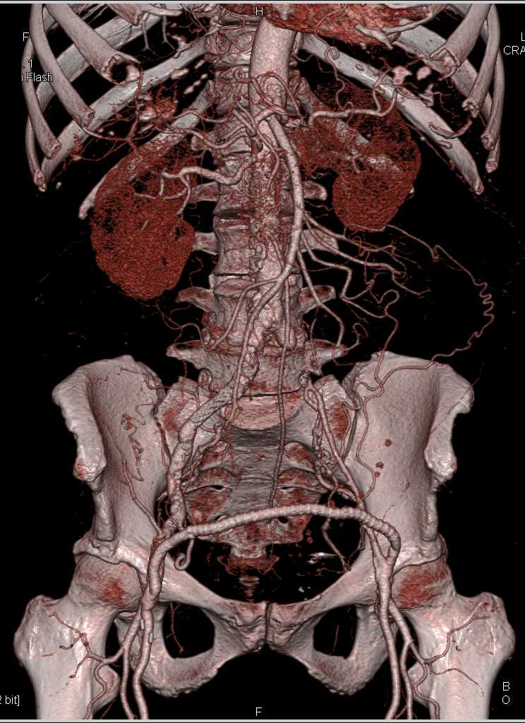Fem-Fem Bypass - CTisus CT Scan