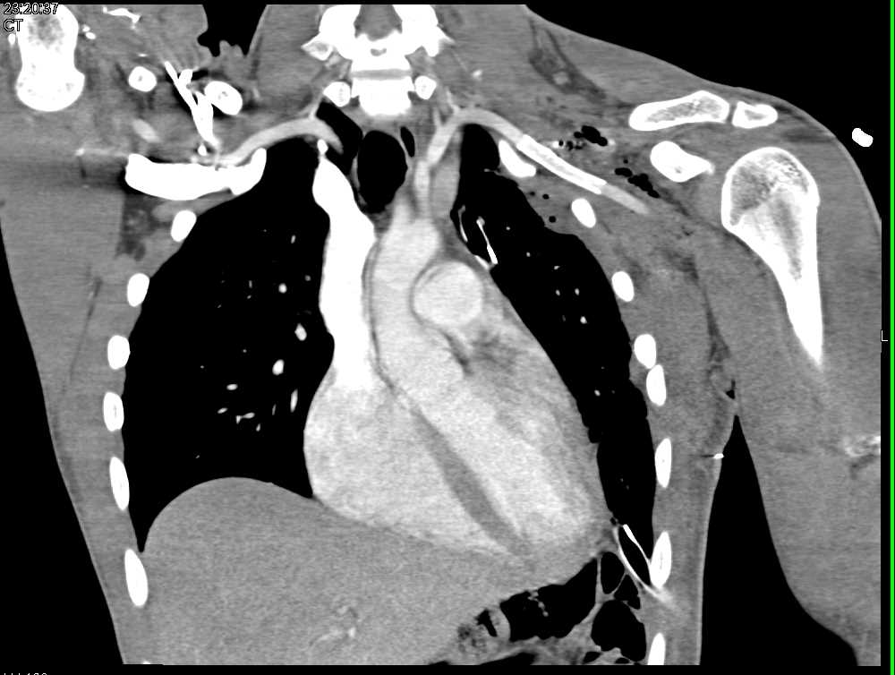 Patent Stent in Left Axillary Artery - CTisus CT Scan