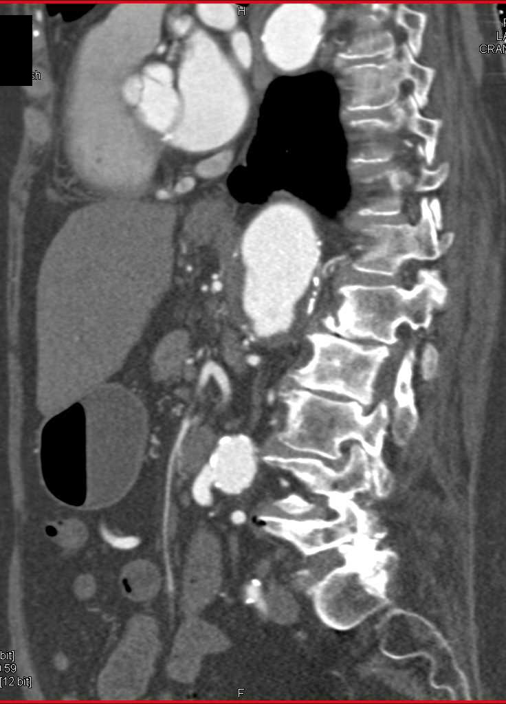 Collateral Patheways due to Celiac Occlusion - CTisus CT Scan