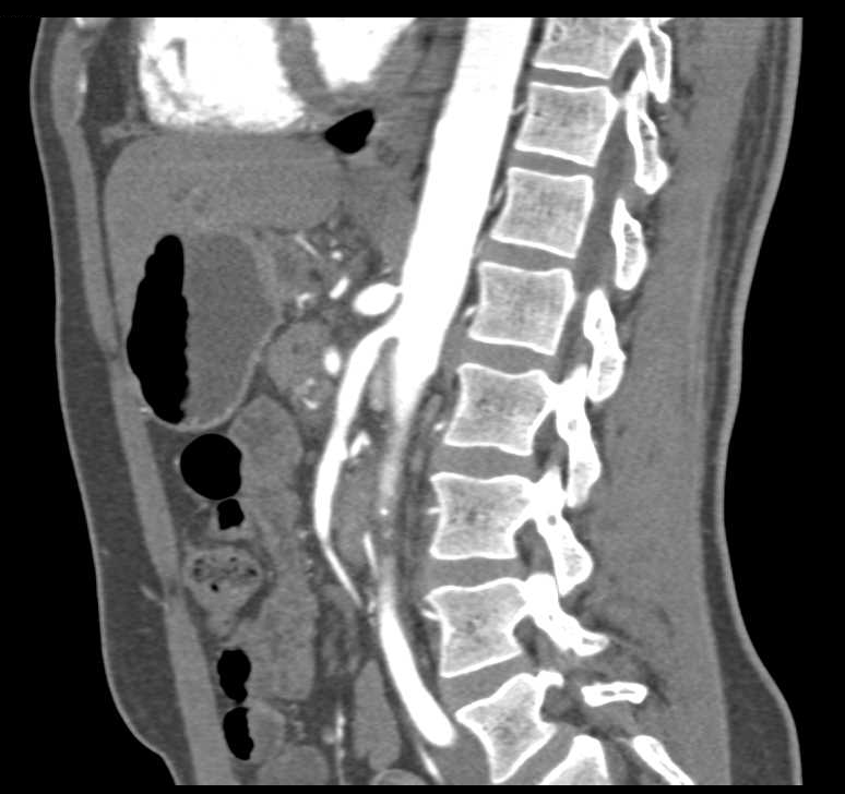 Superior Mesenteric Artery (SMA) Syndrome - CTisus CT Scan