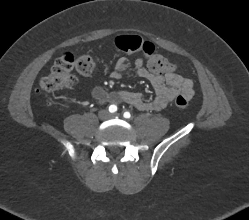 Vascular Bypass Grafts on Runoff Study - CTisus CT Scan