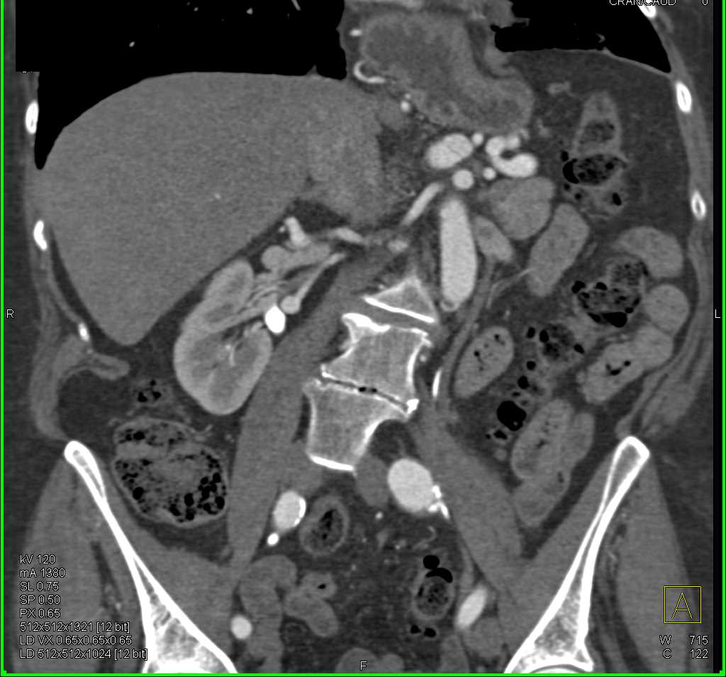 Ehlers-Danlos Syndrome - CTisus CT Scan