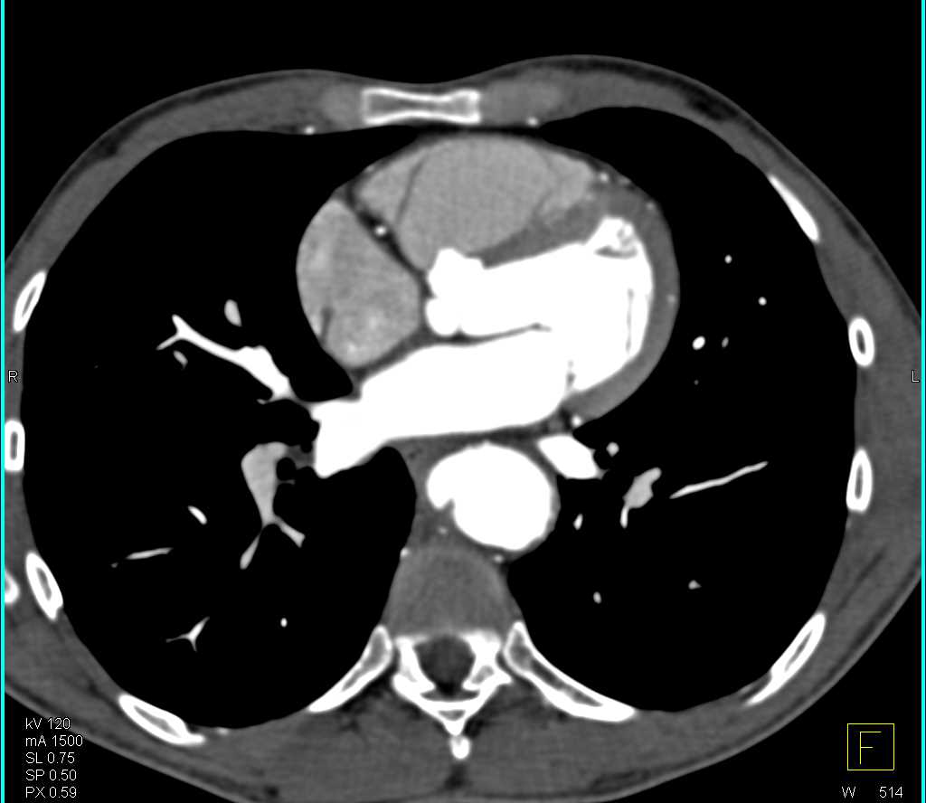 Aneurysm and Ulceration Descending Thoracic Aorta - CTisus CT Scan