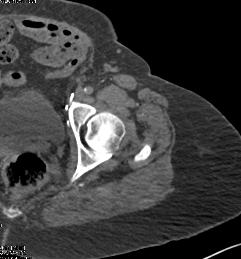 Occluded Left Femoral Artery with Stent Graft - CTisus CT Scan
