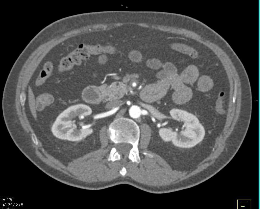 Vasculitis with Thickened Superior Mesenteric Artery (SMA) and Dissection - CTisus CT Scan