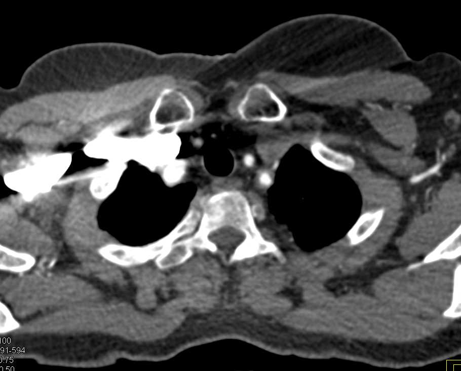 Takayasu's Arteritis Involves Left Subclavian Artery and Other Branch Vessels - CTisus CT Scan