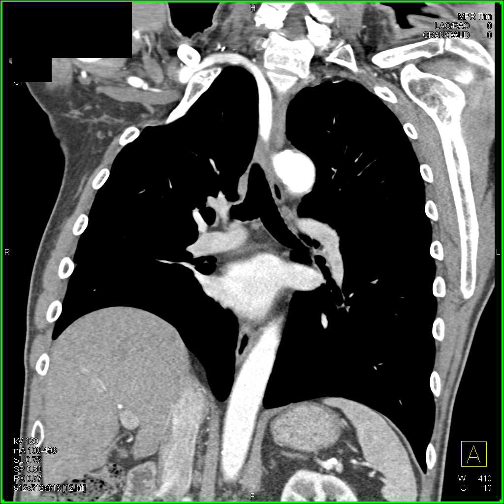Focal Aneurysm of the Right Axillary Artery - CTisus CT Scan