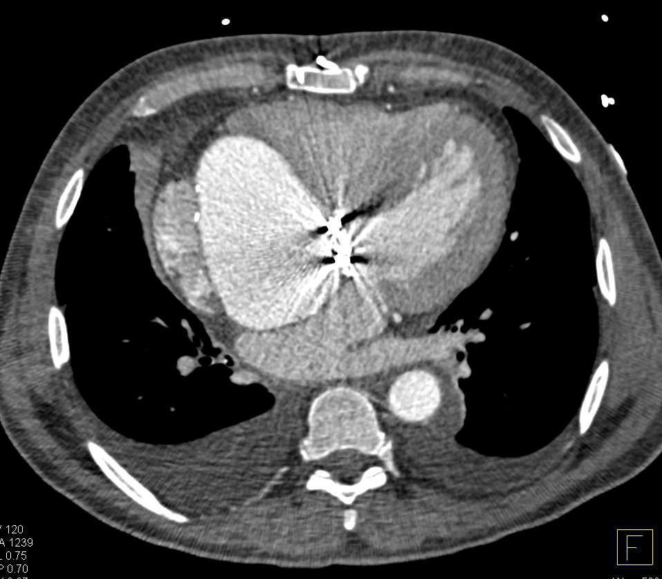 Massive Aneurysm Aortic Root - CTisus CT Scan
