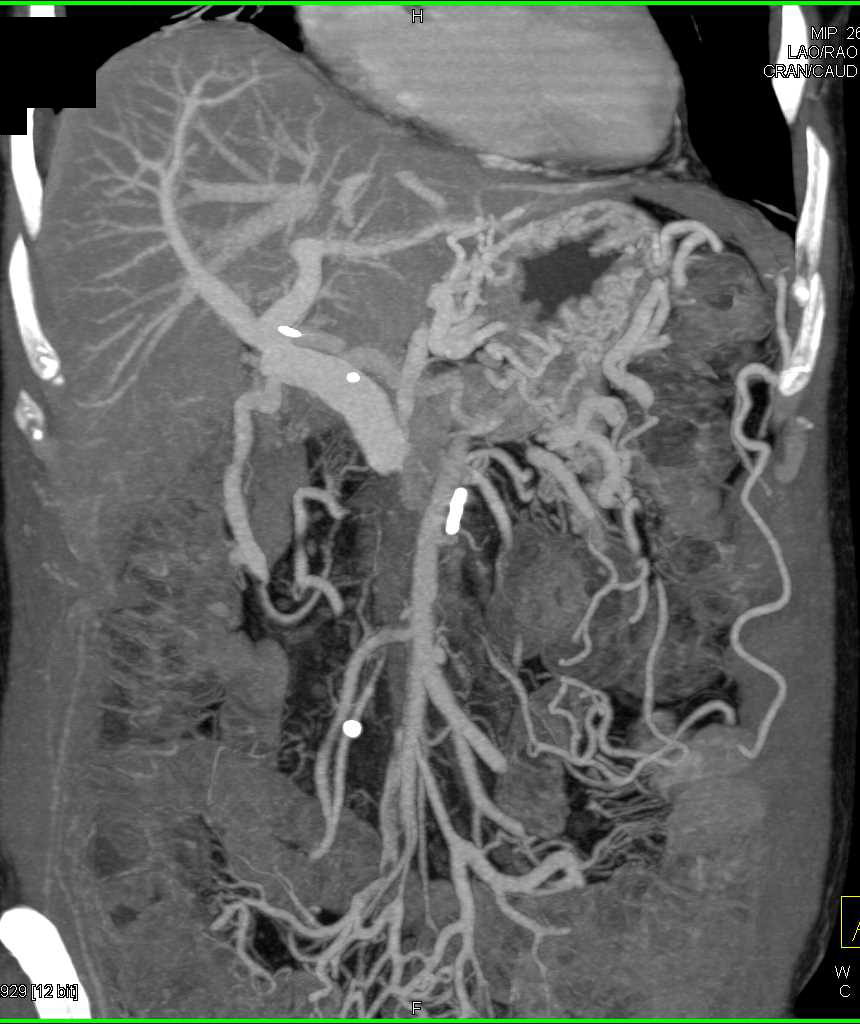 Superior Mesenteric Vein (SMV) Occlusion - CTisus CT Scan