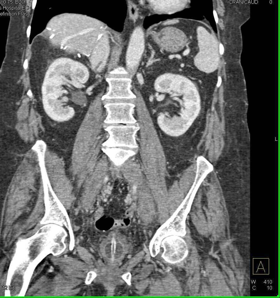 Inferior Vena Cava (IVC) Clot with IVC Stent in Place - CTisus CT Scan