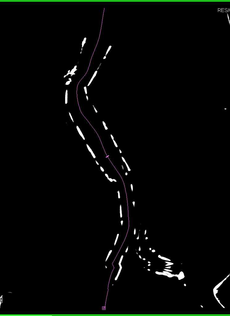 Evaluation of the Endovascular Stent - CTisus CT Scan