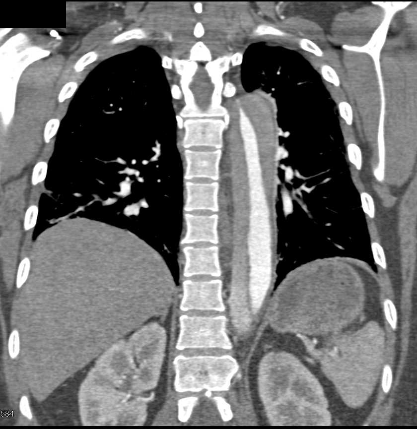 Type B Dissection with an Intramural Hematoma - CTisus CT Scan
