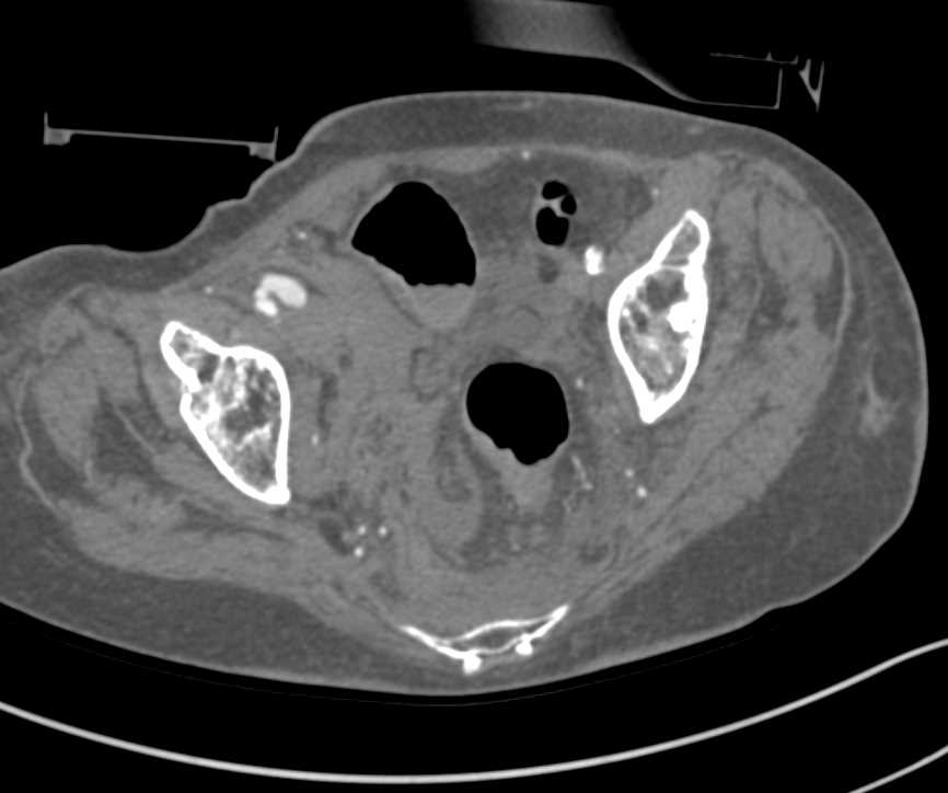 Pseudoaneurysm Right Femoral Artery - CTisus CT Scan