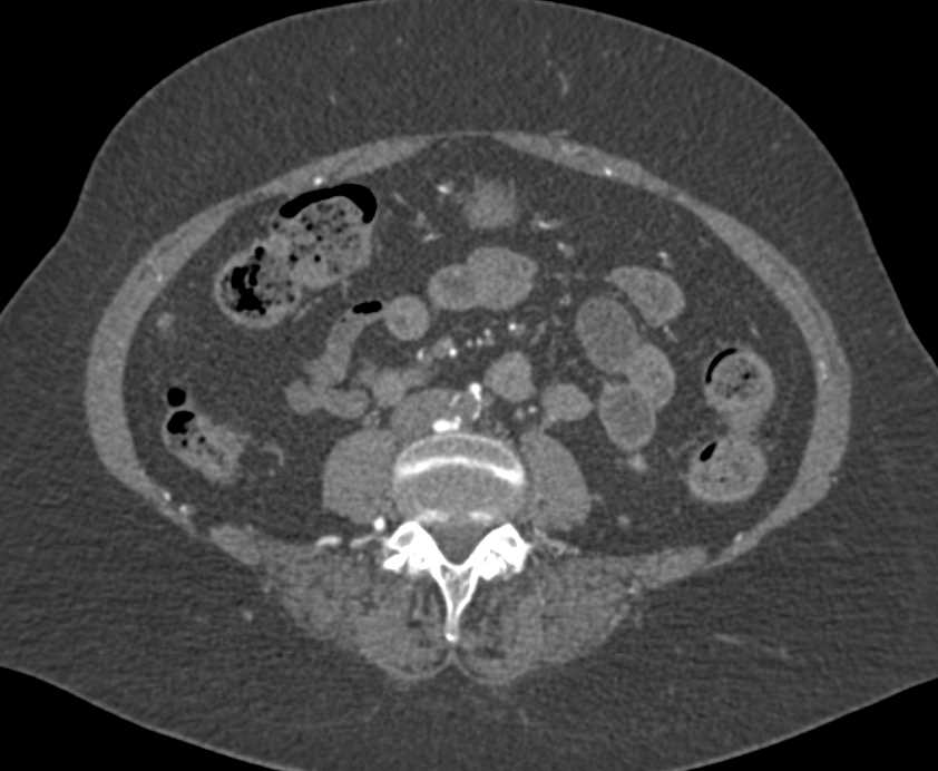 Occluded Abdominal Aorta with Collaterals - CTisus CT Scan