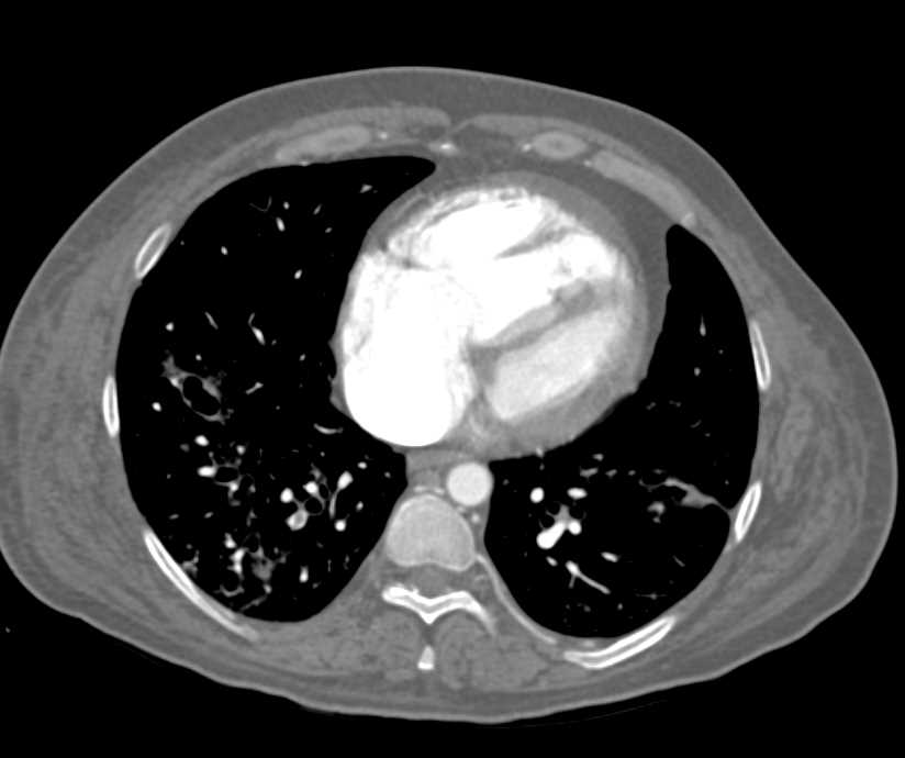 Inferior Vena Cava (IVC) Clot with PE - CTisus CT Scan