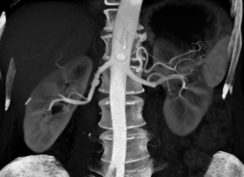 Fibromuscular Dysplasia (FMD) Renal Arteries - CTisus CT Scan