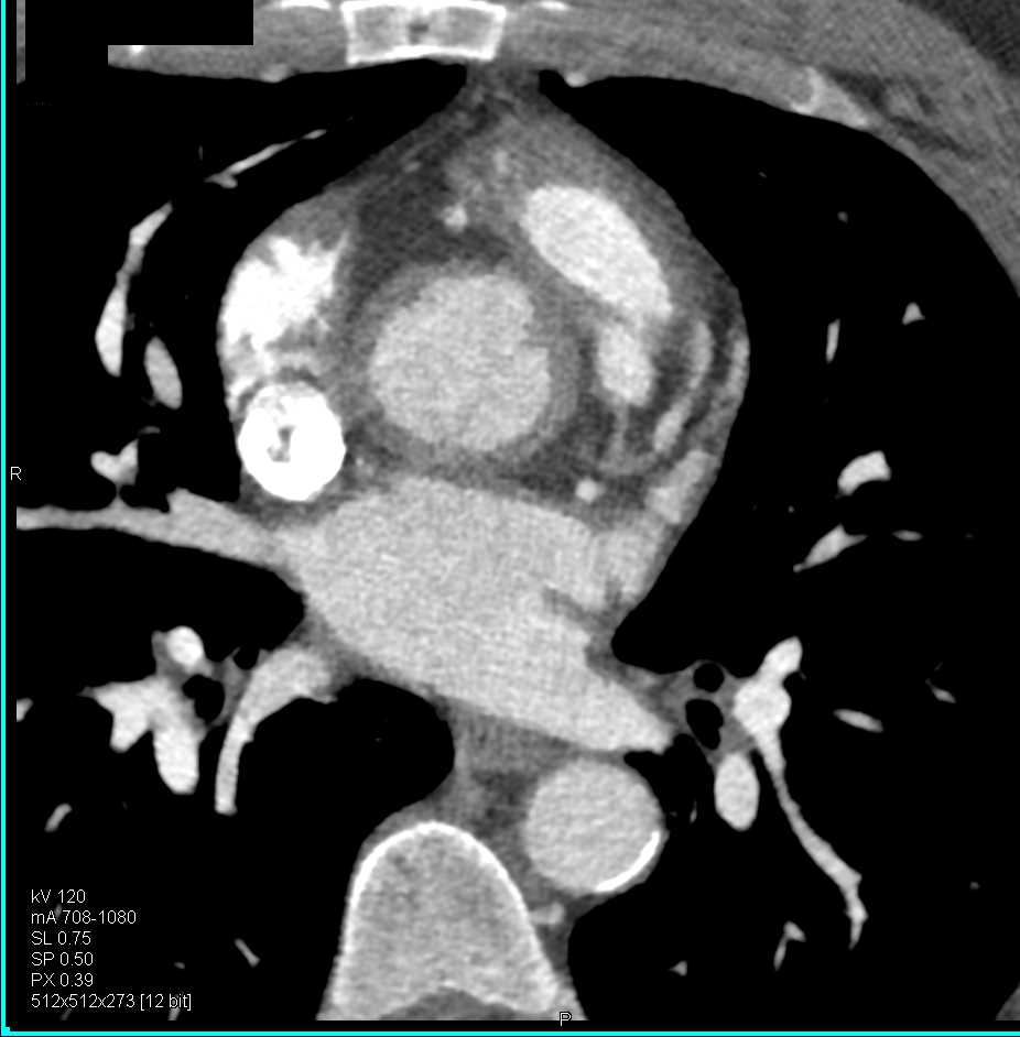 Takayasu's Arteritis Involve the Aortic Root - CTisus CT Scan
