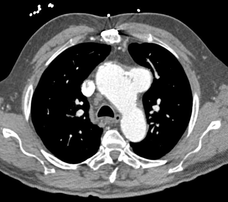 Focal Aneurysm off the Arch - CTisus CT Scan