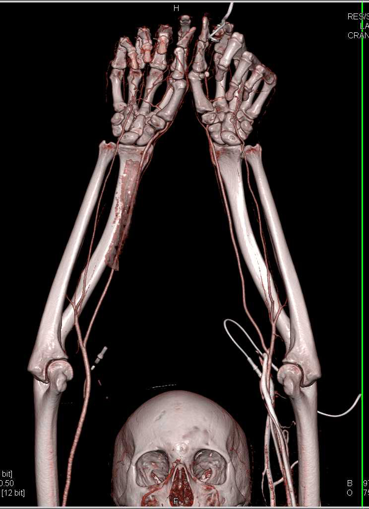CTA of the Upper Extremities with Arm Extended Over the Head - CTisus CT Scan