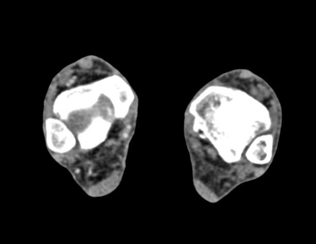 Fem-Fem Bypass Graft with Right Iliac Artery Occlusion and Peripheral Vascular Disease (PVD) - CTisus CT Scan