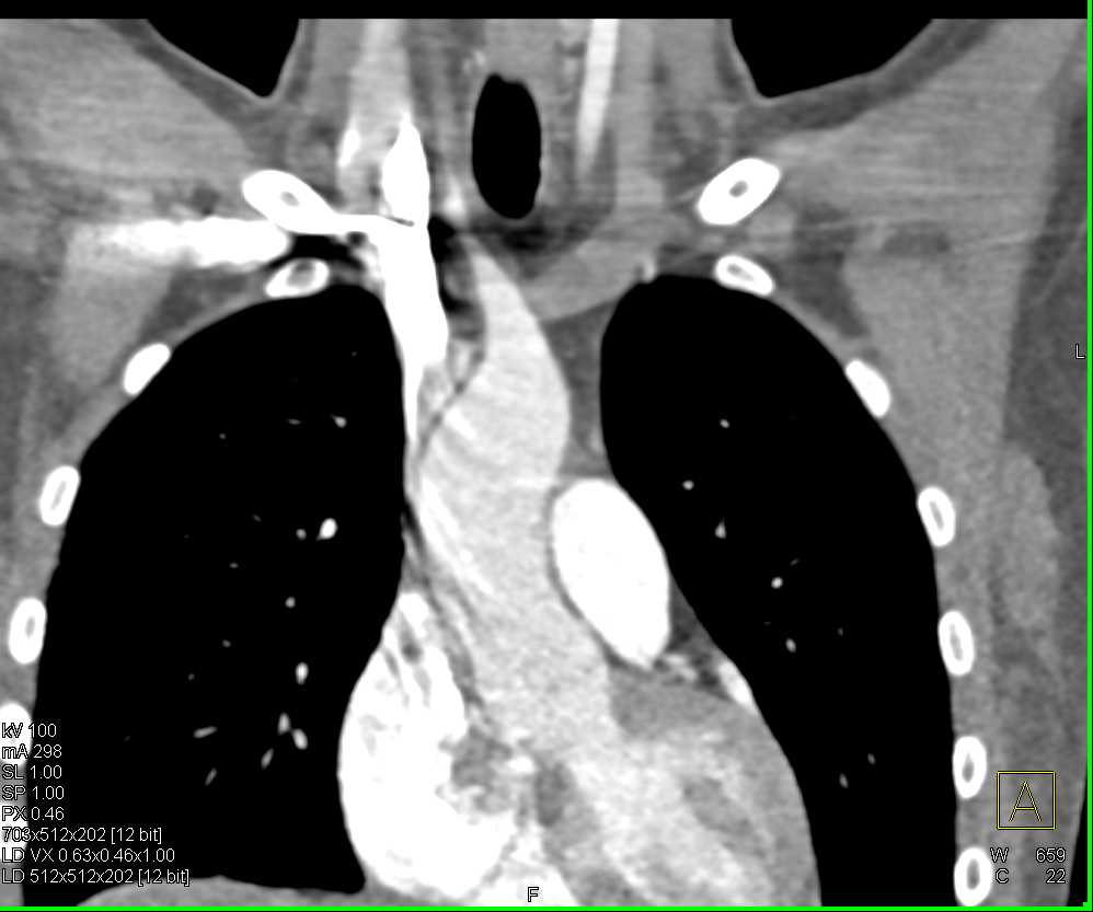 Takayasu's Arteritis Involve the Arch Vessels - CTisus CT Scan