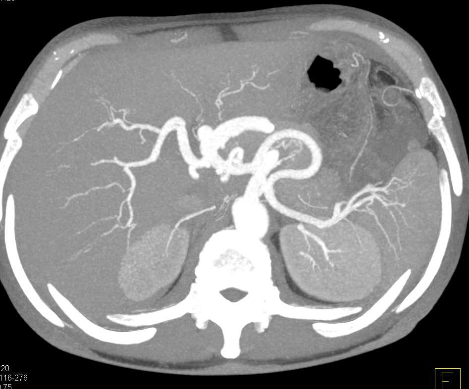 Stenosis Celiac Artery due to Median Arcuate Ligament Compression with Extensive Collaterals - CTisus CT Scan