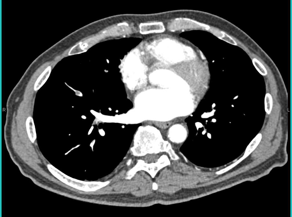 Pulmonary Embolism (PE) and Leaking Abdominal Aortic Aneurysm - CTisus CT Scan