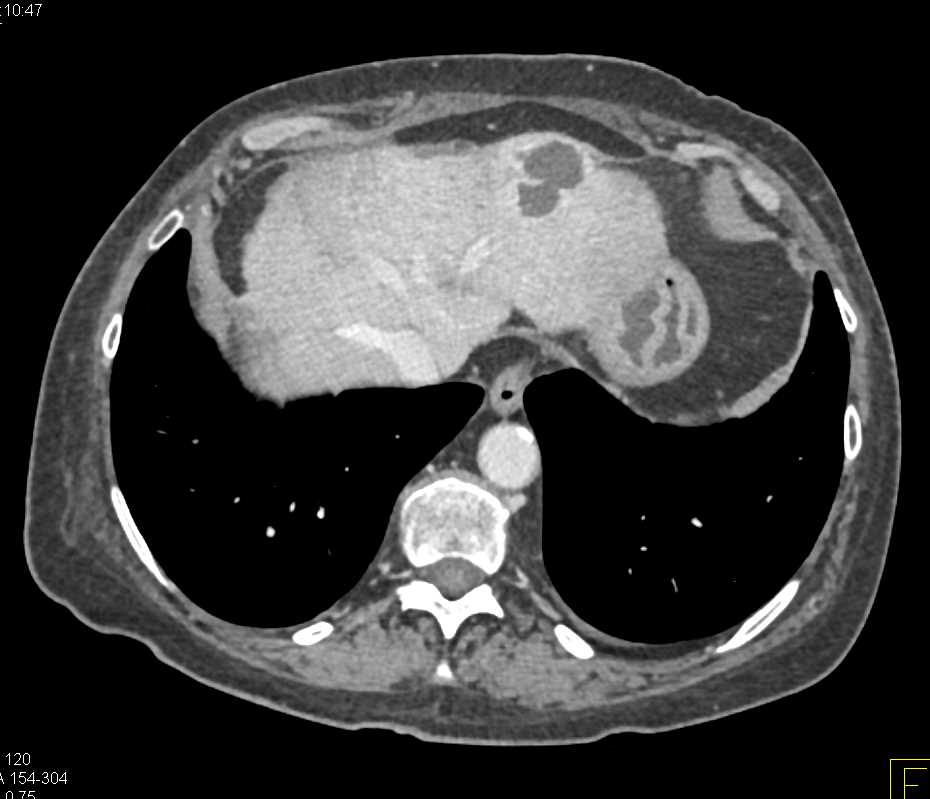 Vasculitis with Beading of Superior Mesenteric Artery (SMA) - CTisus CT Scan