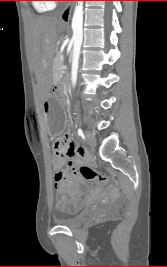 Superior Mesenteric Artery (SMA) Syndrome - CTisus CT Scan