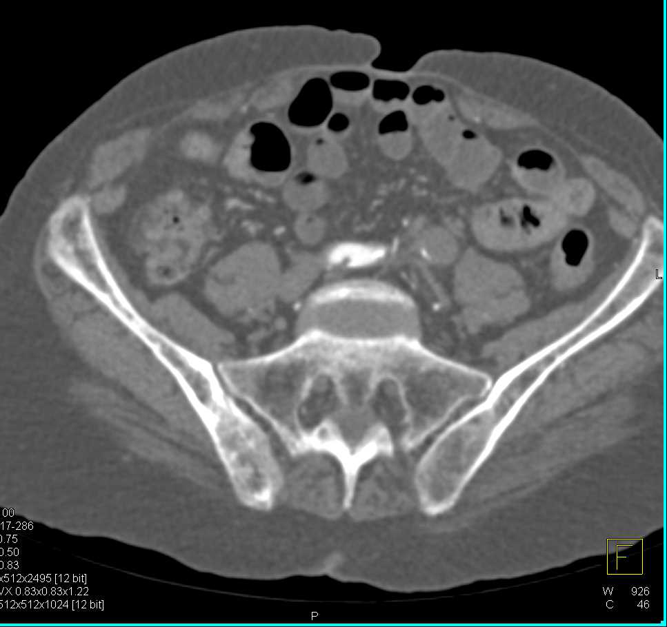 Peripheral Vascular Disease - CTisus CT Scan