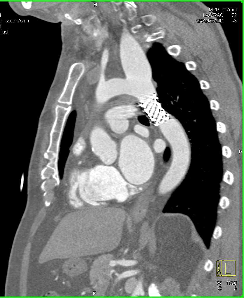 Dilated Left Subclavian Artery in a Patient with Prior Stent Repair of a Coarctation of the Aorta - CTisus CT Scan