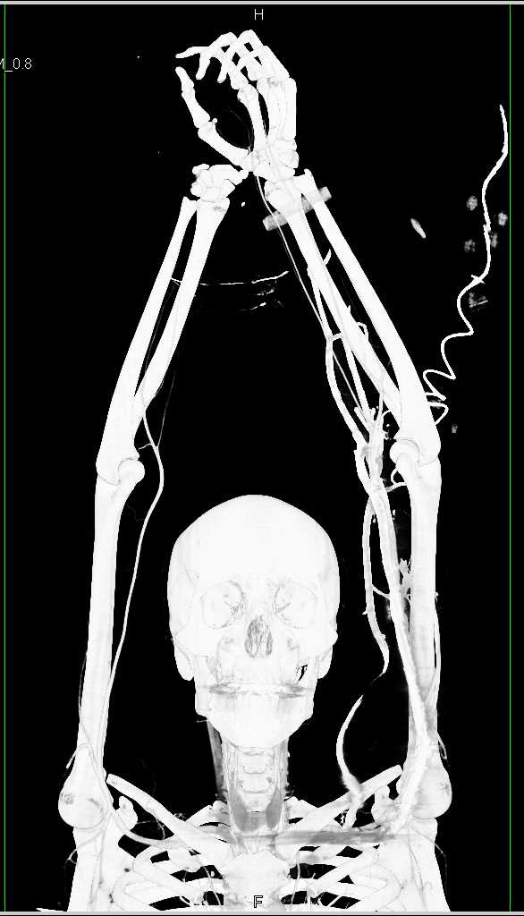 Pre-Op Planning for a Hand Transplant - CTisus CT Scan