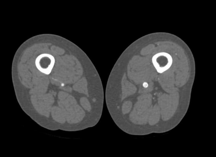 Patent Stent in Superficial Femoral Artery (SFA) with Runoff Study - CTisus CT Scan