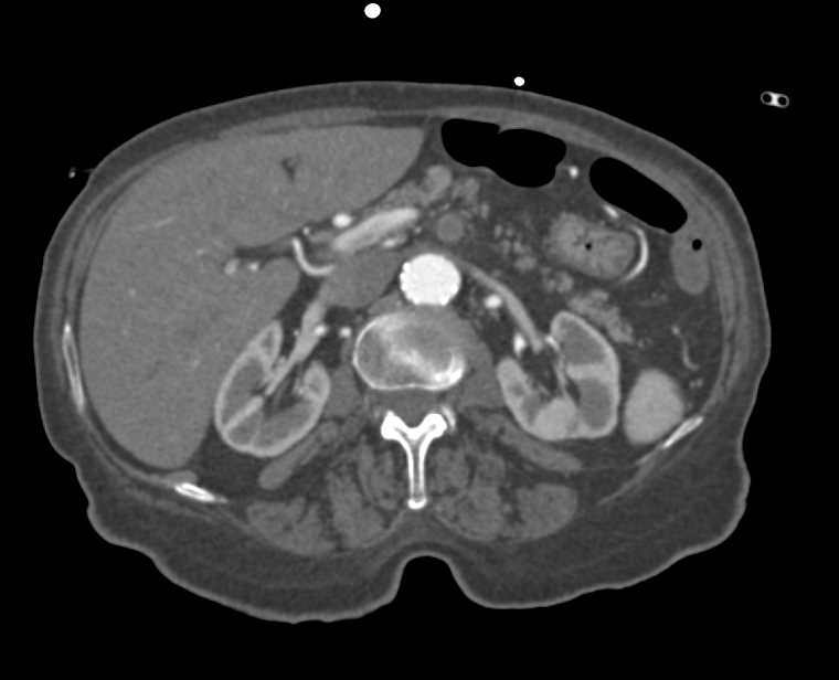 Superior Mesenteric Artery (SMA) Occlusion in a Patient with Atherosclerotic Disease - CTisus CT Scan