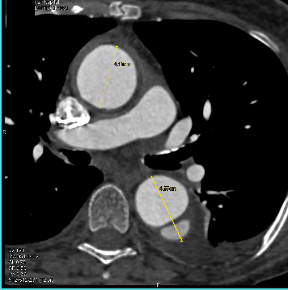 Type B Dissection - CTisus CT Scan
