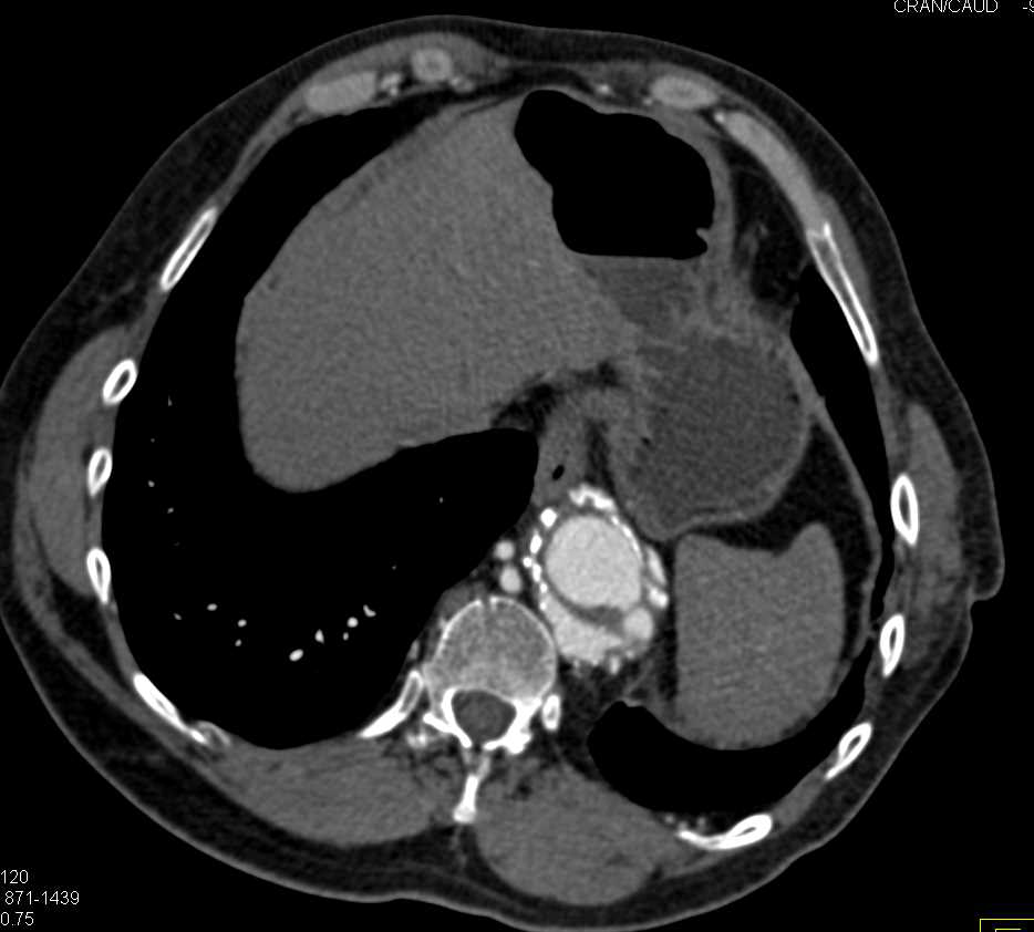 Mycotic Aneurysm Near Superior Mesenteric Artery (SMA) - CTisus CT Scan