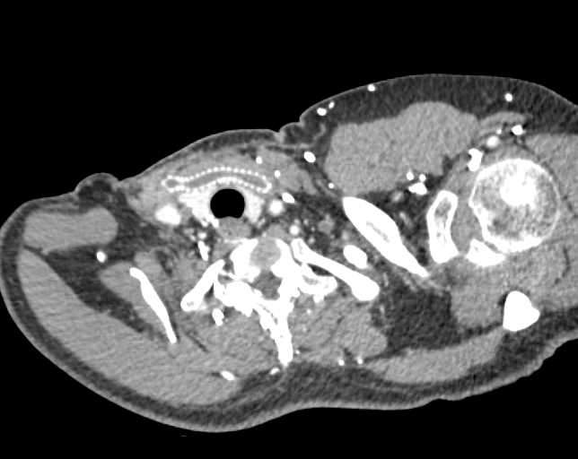 Carotid-Carotid Bypass Graft in Occluded Left Subclavian Artery - CTisus CT Scan