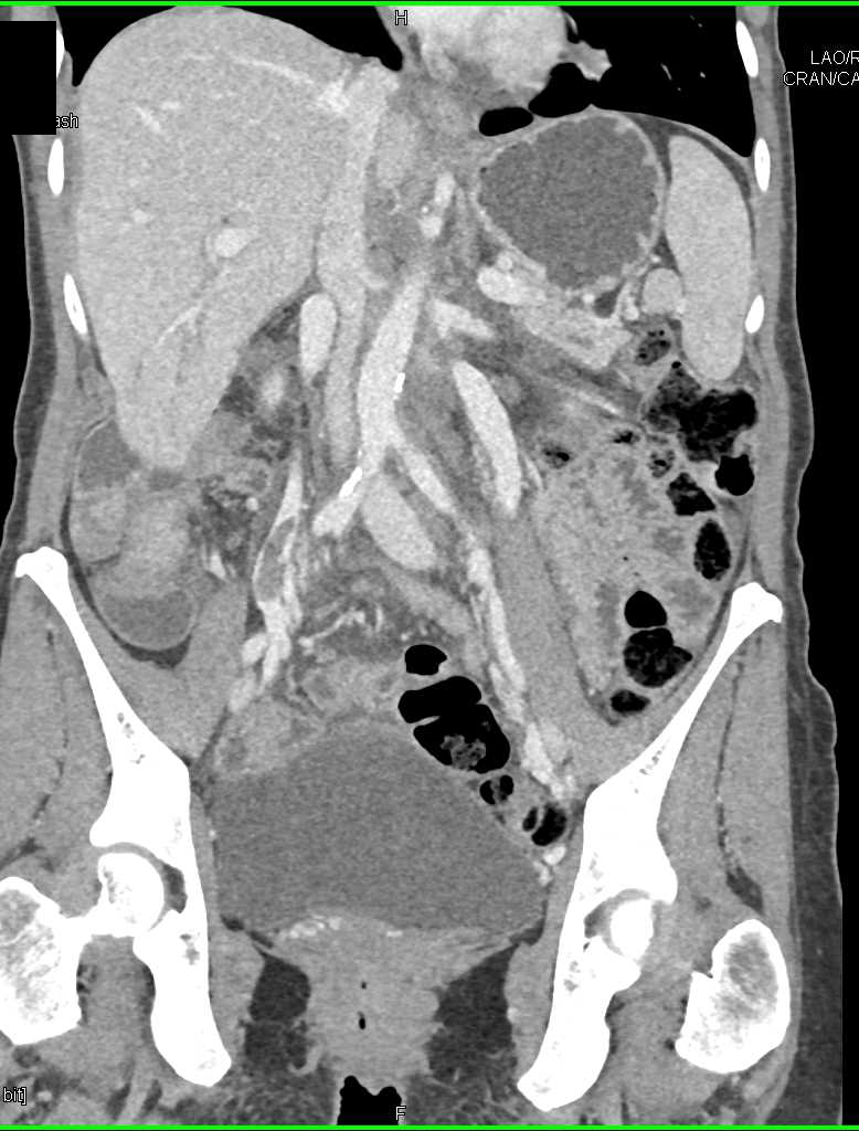 Gonadal Vein Thrombosis on the Right - CTisus CT Scan