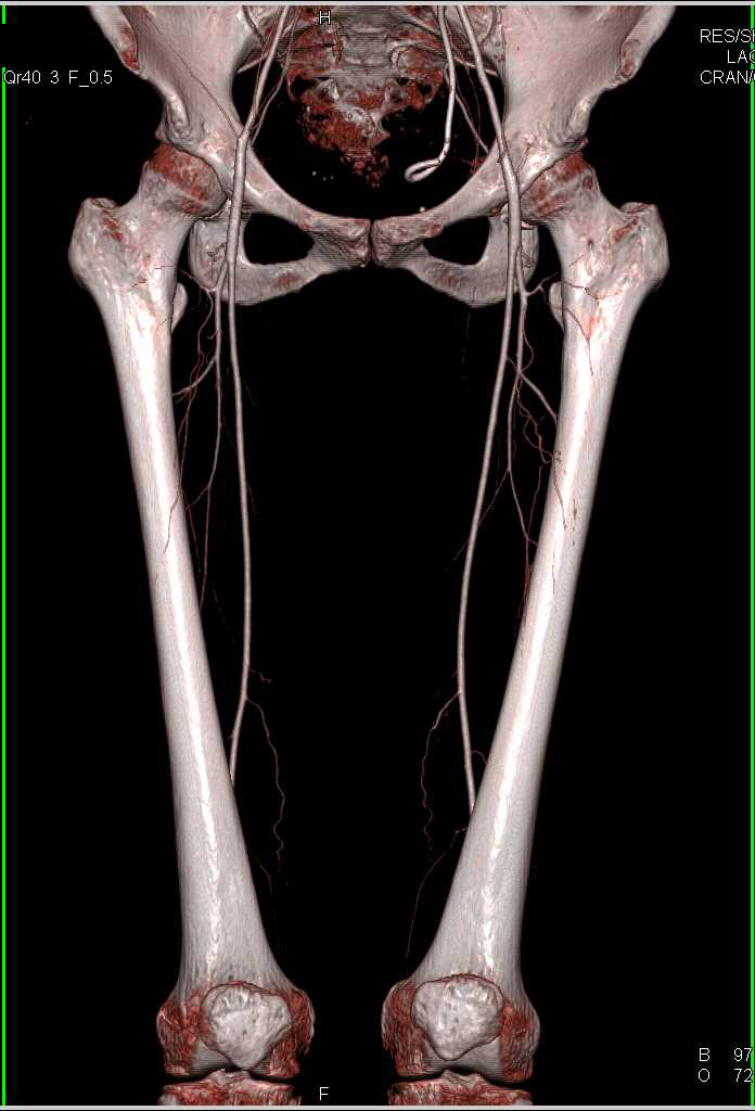 CTA Runoff with Minimal Peripheral Vascular Disease (PVD) - CTisus CT Scan