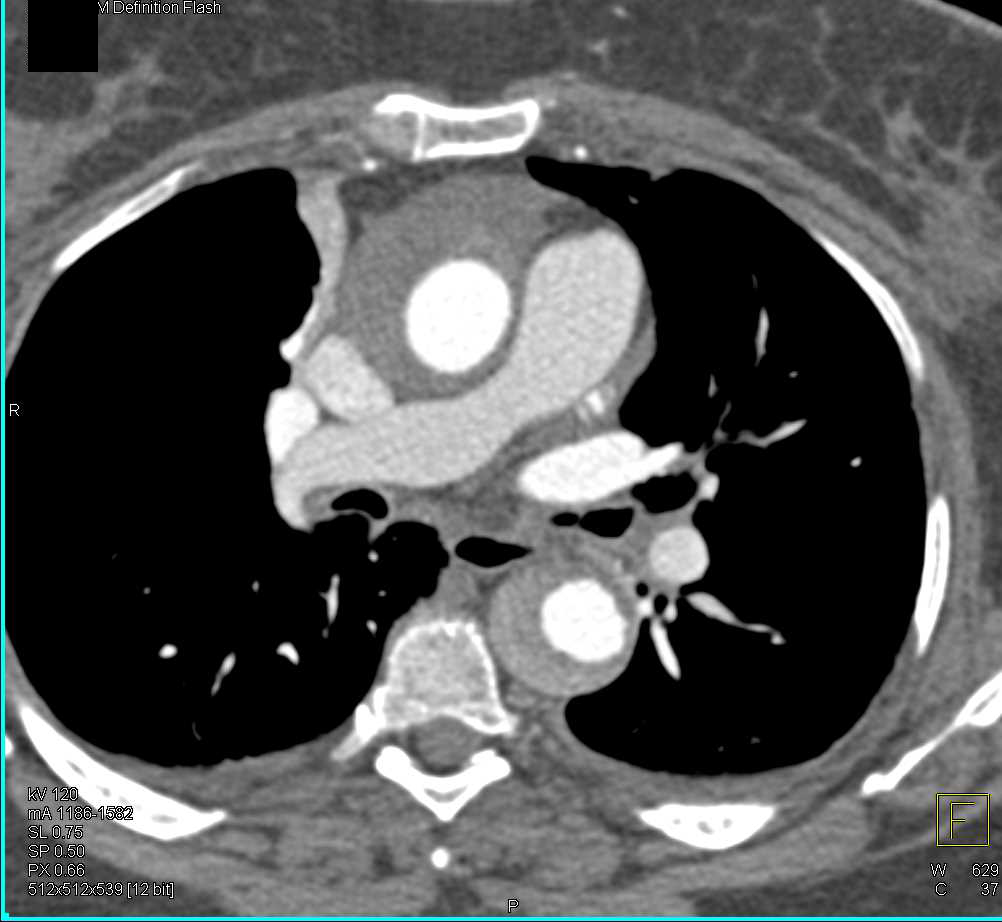 Aortic Dissection with Intramural Hematoma - CTisus CT Scan