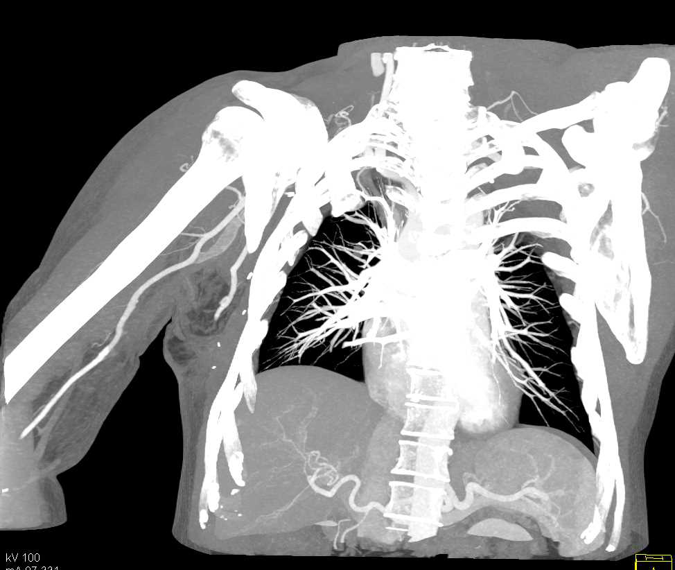 Occluded Right Axillary Artery - CTisus CT Scan