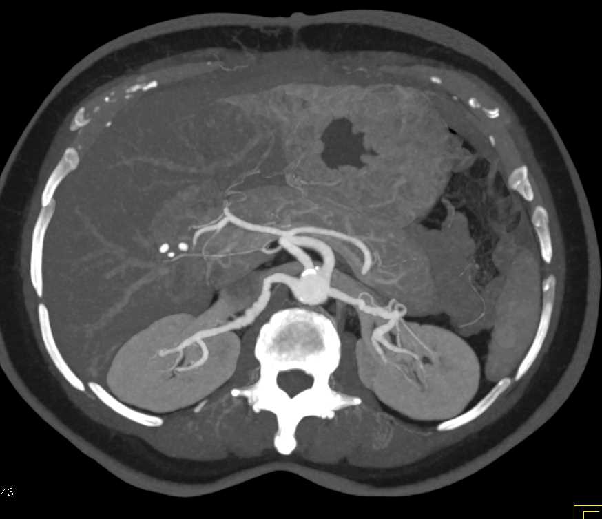 FMD Renal Arteries (Fibromuscular Dysplasia) - CTisus CT Scan