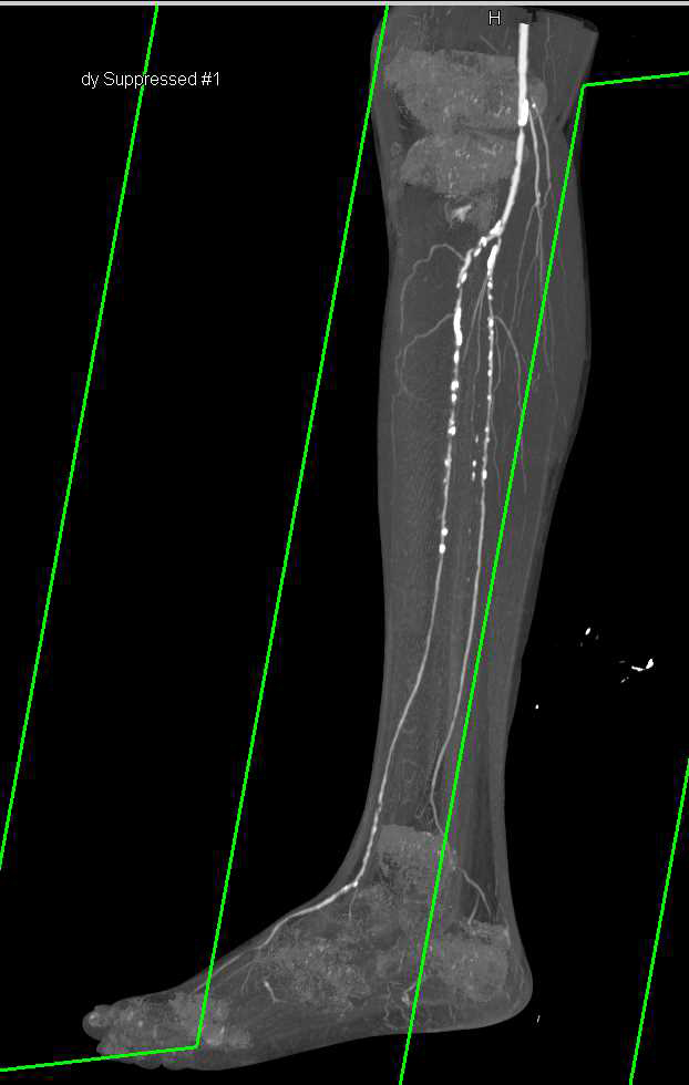 Peripheral Vascular Disease (PVD) with Dual Energy Bone Removal - CTisus CT Scan